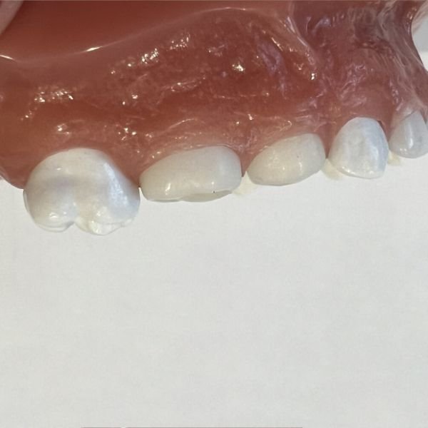 all-ceramic-sprig crown-2-tiny-teeth-of-tally