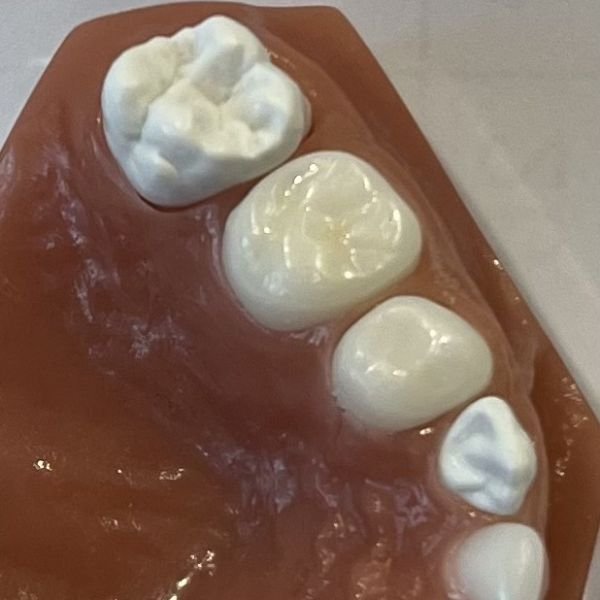 all-ceramic-sprig-crown-tiny-teeth-of-tally
