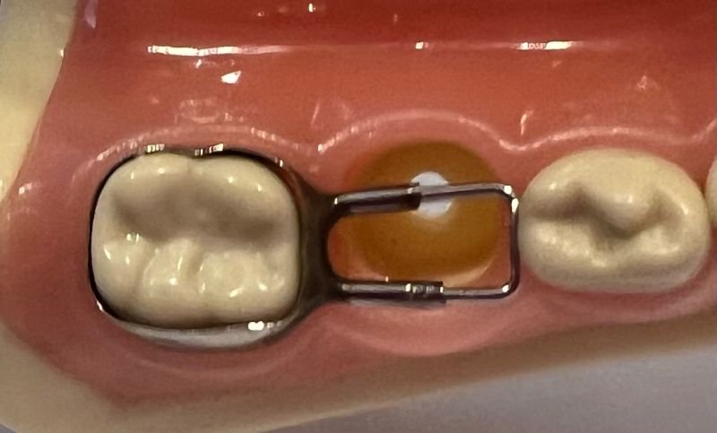band-and-loop space-maintainer-tiny-teeth-of-tally