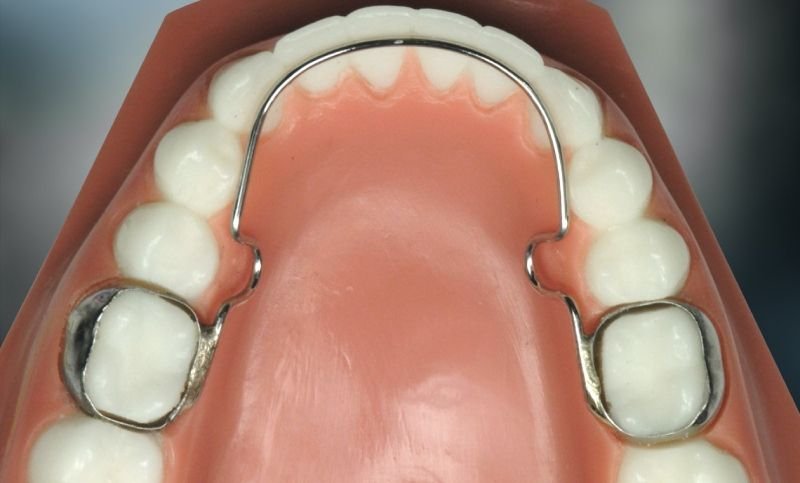 lower-lingual-holding-arch-tiny-teeth-of-tally