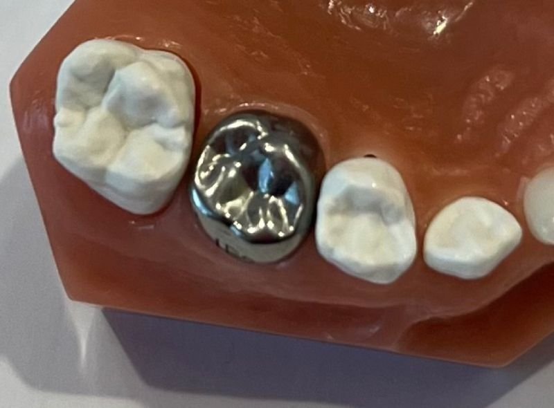 stainless-steel-crown-2-tiny-teeth-of-tally
